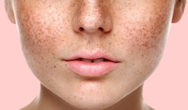 Freckles treatment 1